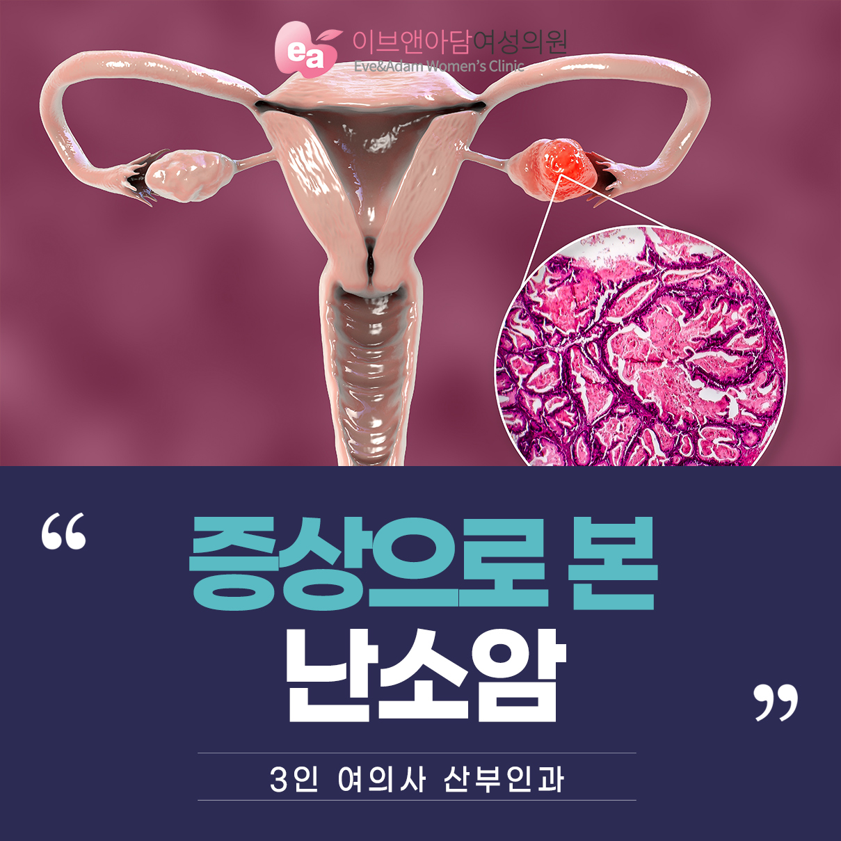 자궁근종